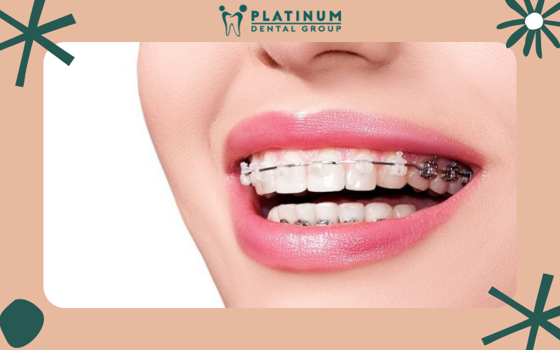Những yếu tố ngoài ảnh hưởng tới thời gian tháo niềng răng