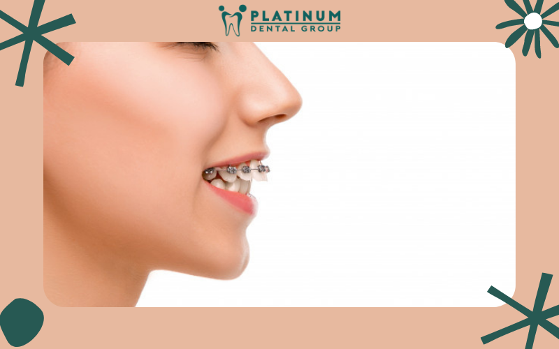 Thói quen ăn uống ảnh hưởng đến thời gian niềng răng