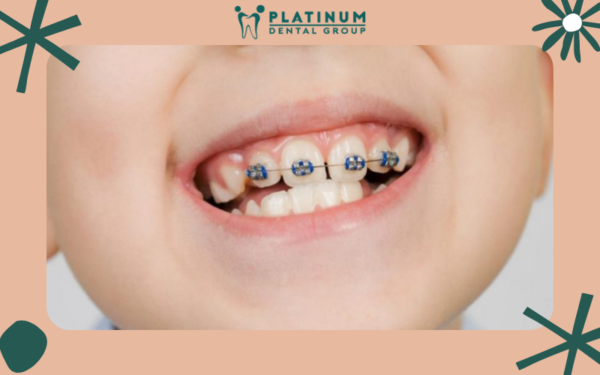 Niềng răng cho trẻ vào độ tuổi nào là thích hợp?