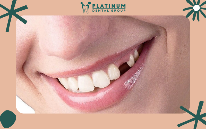 Những lí do bị rụng răng sớm ở những người trẻ tuổi