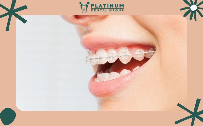Niềng răng đã bọc răng sứ