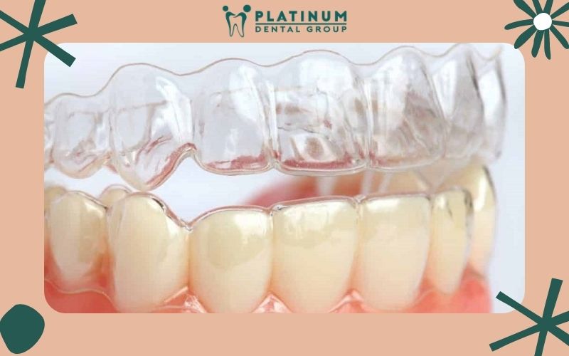 Dùng máng trong suốt invisalign để bảo vệ răng sứ Dùng máng trong suốt invisalign để bảo vệ răng sứ