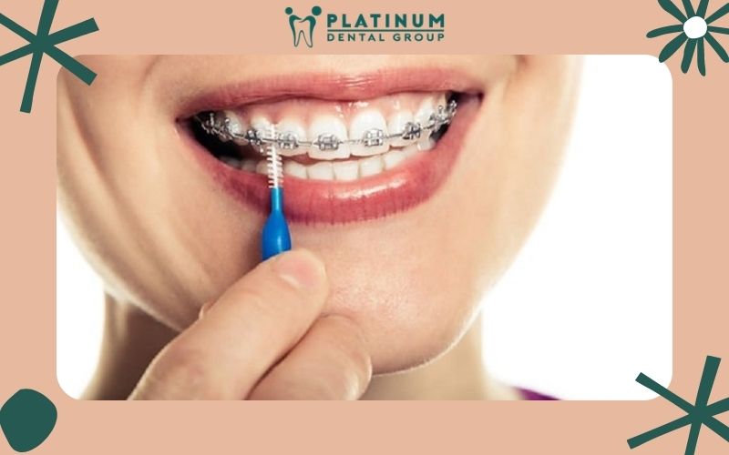 Niềng răng giúp ăn nhai dễ dàng hơn