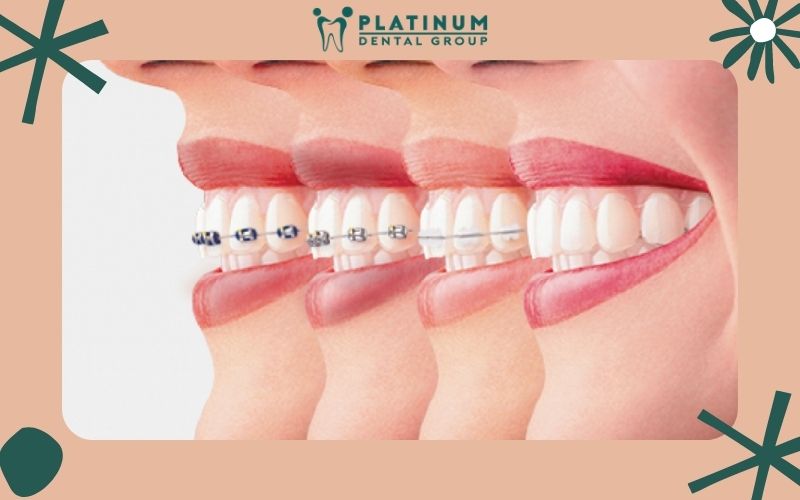 Quá trình niềng răng thường kéo dài 12 - 24 tháng