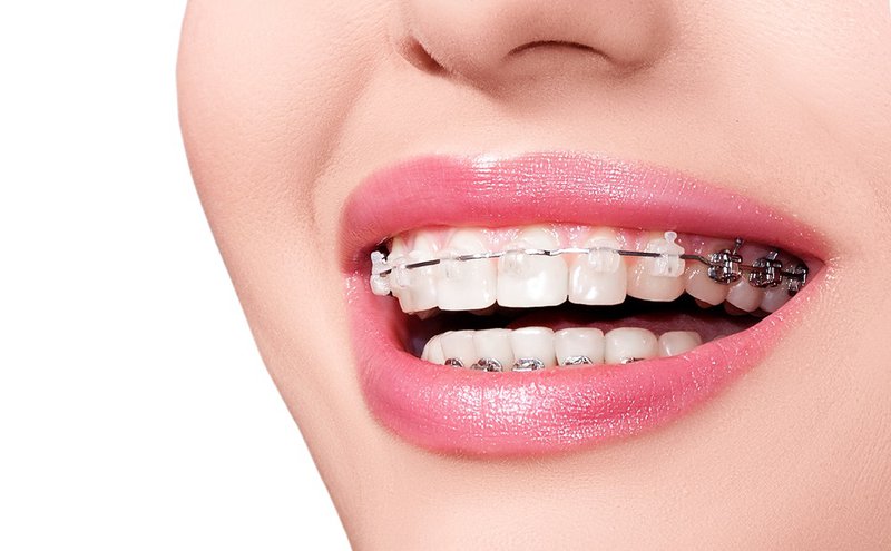 Giải đáp thắc mắc niềng răng giai đoạn nào đau nhất