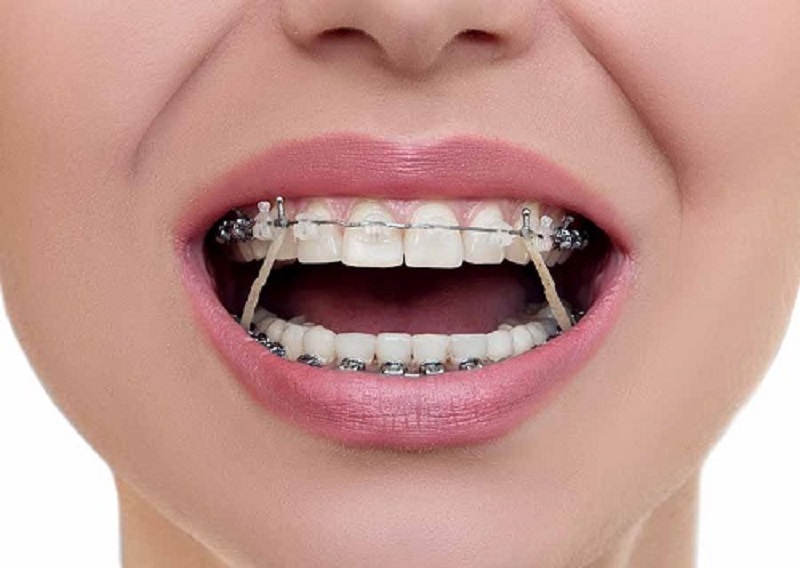 Giải đáp thắc mắc niềng răng giai đoạn nào đau nhất