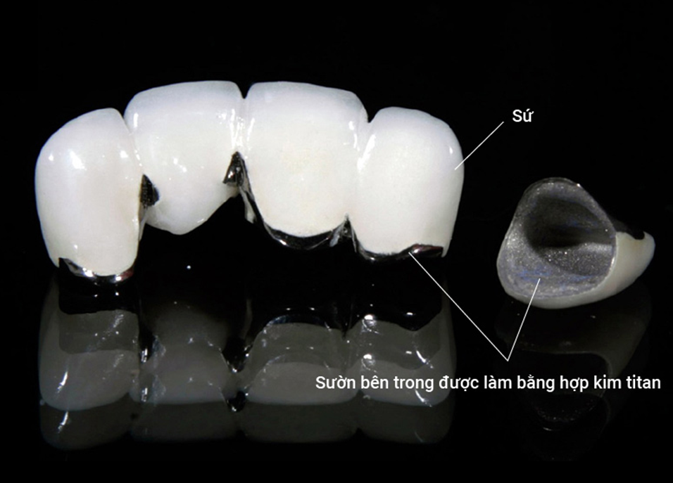 Bọc răng sứ Titan có bị đen không