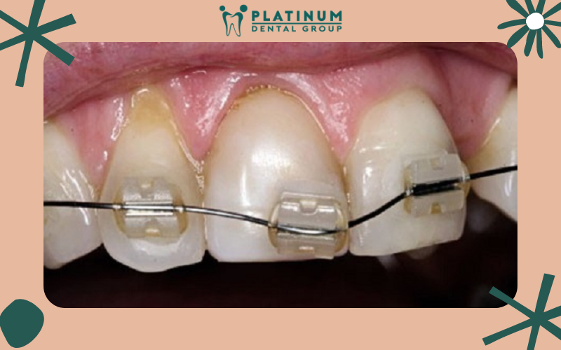 Niềng răng sai kỹ thuật