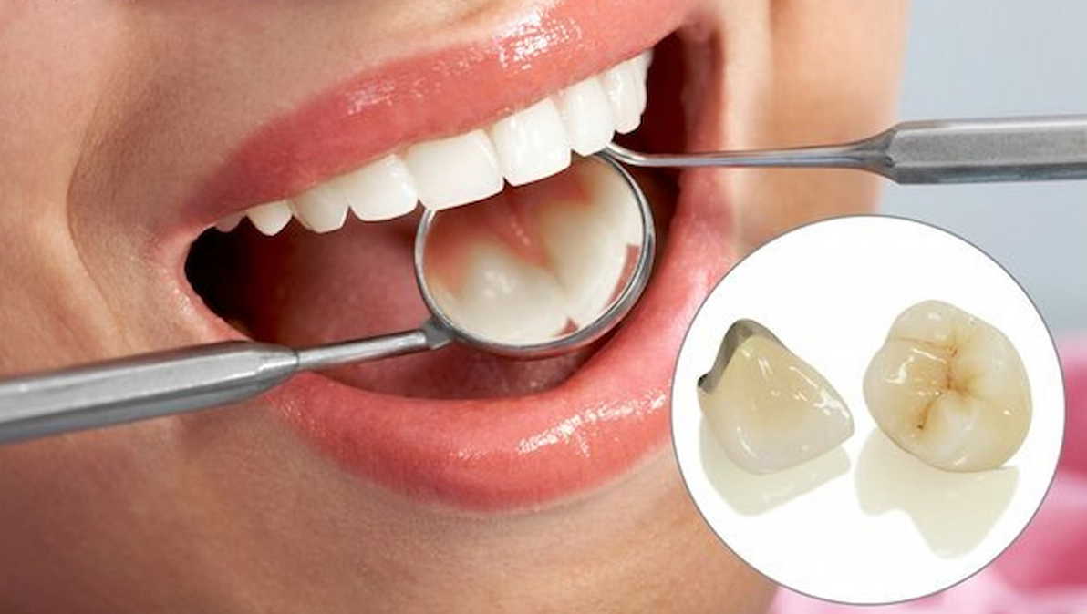 Làm răng sứ bao lâu thì bị đen viền nướu