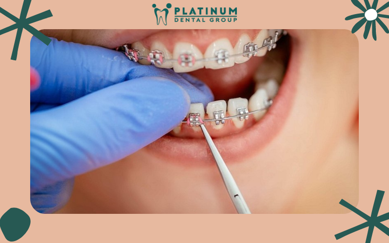 Các trường hợp cần thiết phải bắt vít khi niềng răng?