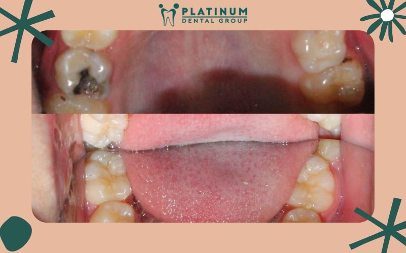 Các loại móm răng phổ biến hiện nay
