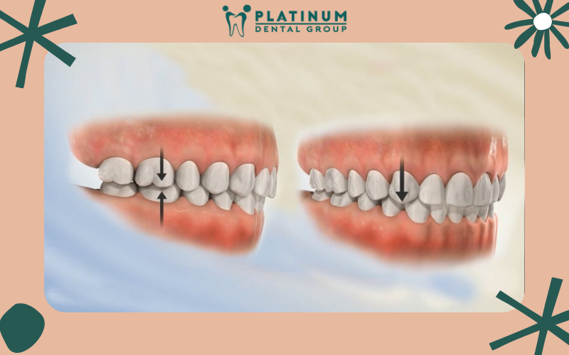 BSSO - kỹ thuật điều trị móm răng mà không cần phải nhổ