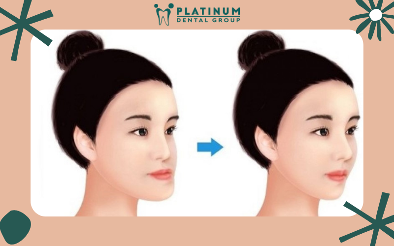 Quy trình thực hiện kỹ thuật móm răng