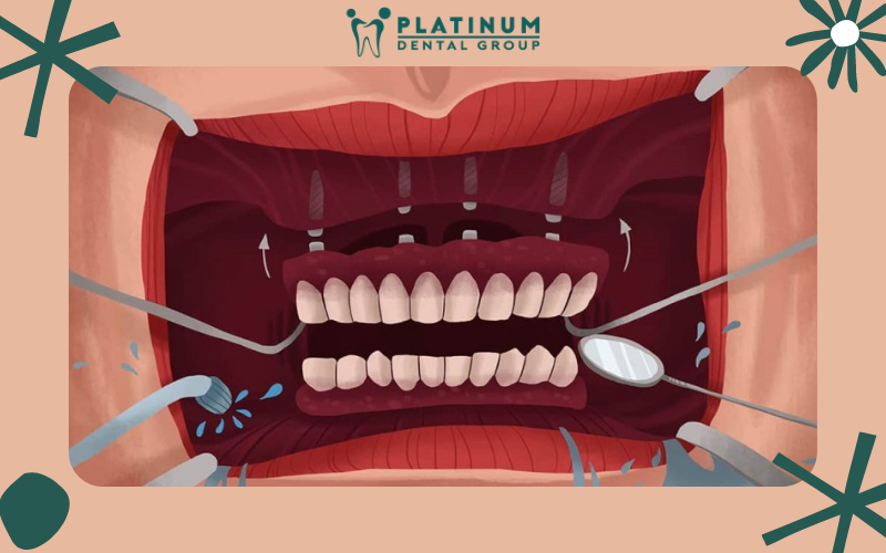 Ưu điểm của phương pháp cạo vôi răng