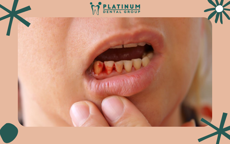 Cách cầm máu cho lợi sau khi nhổ răng khôn
