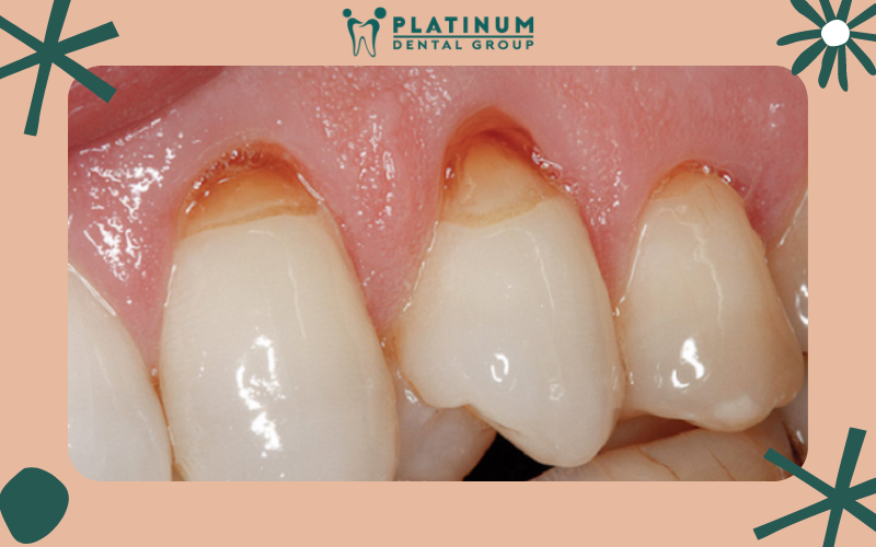 Những biến chứng nguy hiểm nếu để mòn răng kéo dài