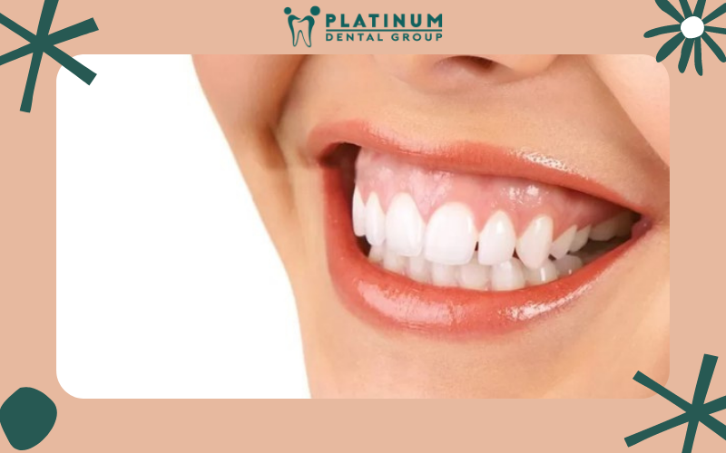 Tụt lợi làm mất đi sự tự tin của nụ cười