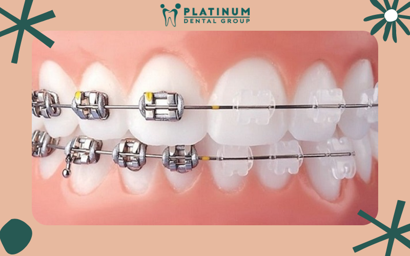 Phương pháp cắm vít niềng răng là gì?