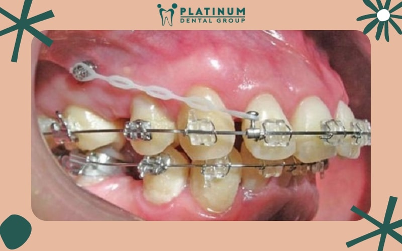 Những ai nên sử dụng phương pháp cắm vít niềng răng