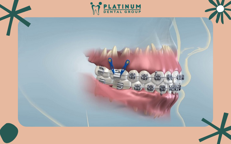 Quy trình thực hiện phương pháp cắm vít niềng răng