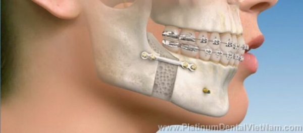 Phẫu thuật chỉnh hàm kết hợp chỉnh nha là một loại điều trị nhằm mục đích