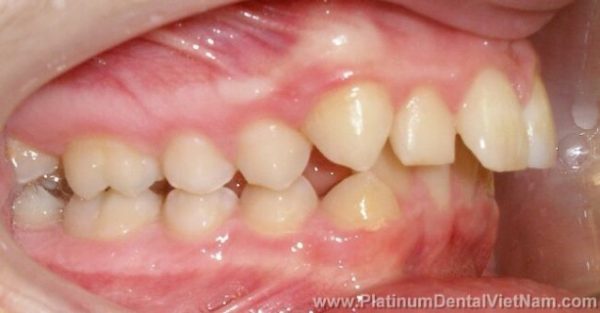 Hiện tượng hô hàm trên là do tình trạng các răng cửa hàm trên nhô ra phía trước
