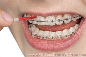Dùng nước súc miệng kháng khuẩn