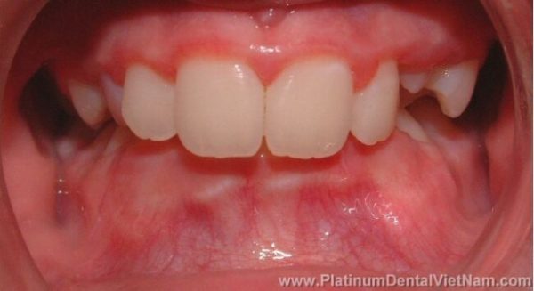 Tình trạng khớp cắn sâu là khi hai hàm răng cắn khớp lại