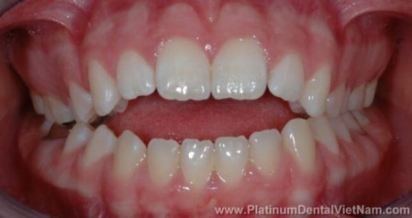 Cắn hở là tình trạng các răng cửa hàm trên và hàm dưới không chạm vào nhau