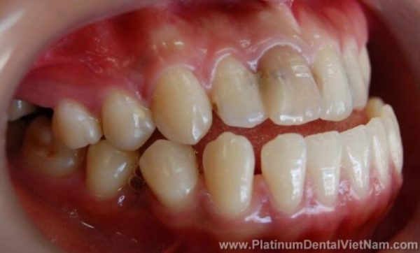 Tỉ lệ dân số có hàm dưới lớn, nhô ra trước so với hàm trên là 3-5%