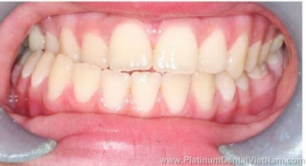 Tình trạng răng cửa hàm trên cắn khớp vào phía trong răng cửa hàm dưới