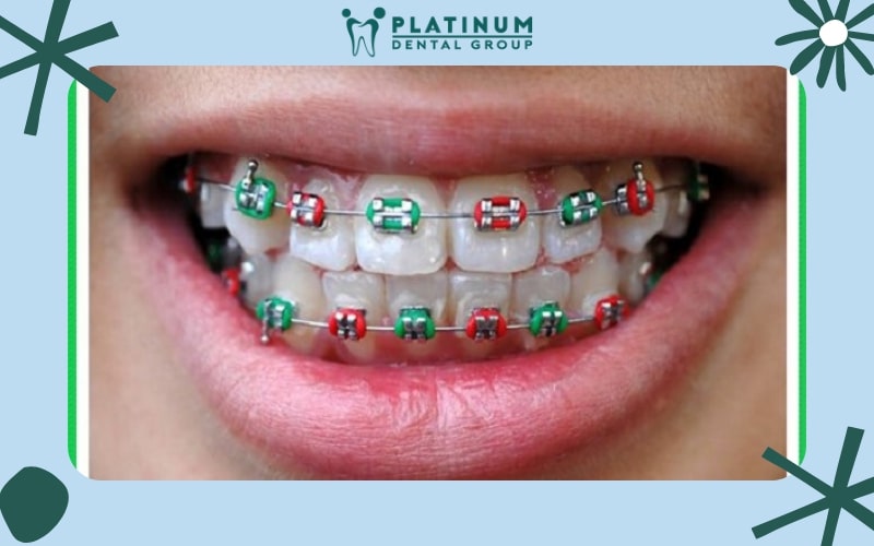 Niềng răng là phương pháp làm đẹp đang rất được ưa chuộng, tuy nhiên bạn cần biết cách chăm sóc sau niềng răng để đảm bảo sức khỏe răng miệng.