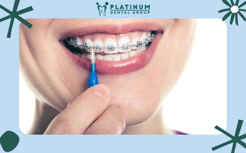 Bàn chải chuyên dụng giúp làm sạch kĩ tất cả các mảng bám và thức ăn thừa sót lại trên mắc cài và dây cung.