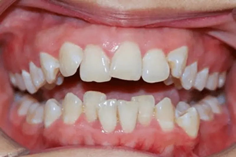 Răng mọc lệch lạc