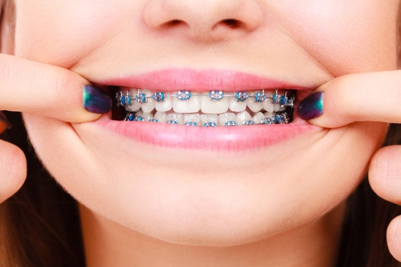 Có nên niềng răng không? | platinumdentalvietnam.hiseo.vn