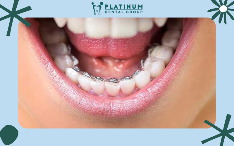 Những điều cần biết về niềng răng mắc cài trong