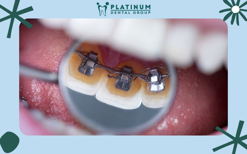 Những điều cần biết về niềng răng mắc cài trong