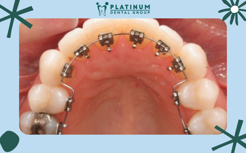 Những điều cần biết về niềng răng mắc cài trong