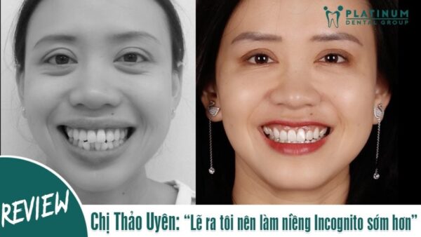 Yếu tố ảnh hưởng đến thời gian niềng răng