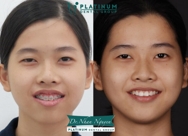 Chị Quách Đông Anh đã thu được “trái ngọt” khi khắc phục được hoàn toàn tình trạng hở nướu sau khoảng thời gian đồng hành cùng các bác sĩ Platinum Dental.