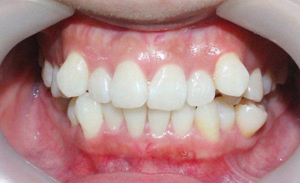 Hình ảnh một hàm răng bị khấp khểnh.