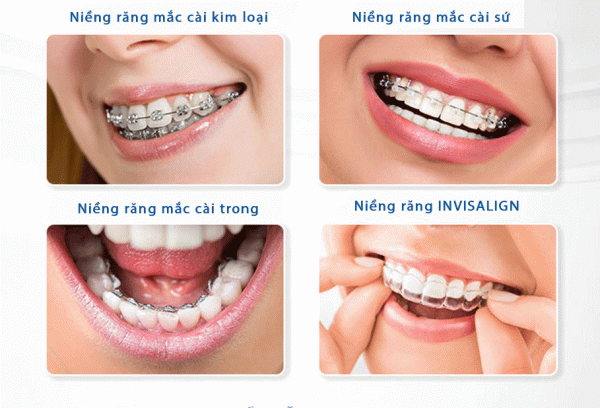 Có nhiều loại niềng răng khác nhau phù hợp với nhu cầu mọi người