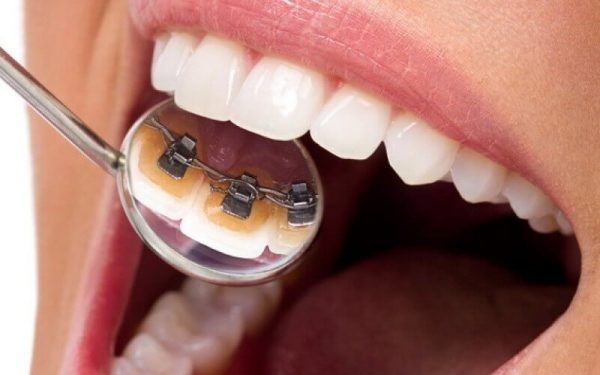Niềng trong mang tính thẫm mỹ khá cao trong quá trinh niềng