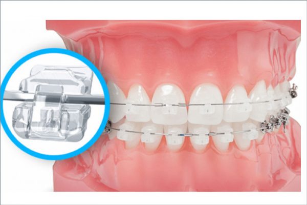 Cũng như loại mắc cài kim loại truyền thống tự buộc nhưng có màu sứ trùng màu răng nên có thêm ưu điểm thẩm mỹ