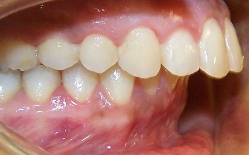 Răng hô nặng sẽ khiến những chiếc răng chìa hẳn ra ngoài, kém duyên và làm bệnh nhân cực kì mất tự tin Răng hô nặng sẽ khiến những chiếc răng chìa hẳn ra ngoài, kém duyên và làm bệnh nhân cực kì mất tự tin