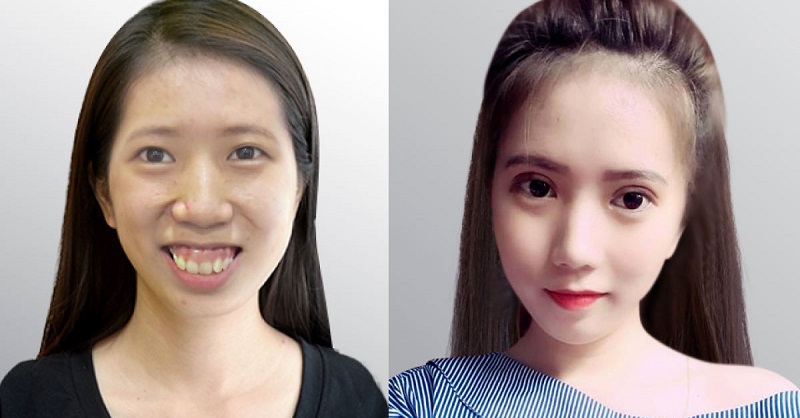 Răng hô nặng sẽ khiến bệnh nhân không thoải mái và tự tin khi giao tiếp, đồng thời dễ gặp nhiều trở ngại về tâm lý. Răng hô nặng sẽ khiến bệnh nhân không thoải mái và tự tin khi giao tiếp, đồng thời dễ gặp nhiều trở ngại về tâm lý.