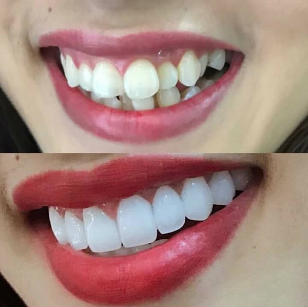 Bọc răng sứ cũng là phương pháp cải thiện răng hô nhanh chóng và đem lại hiệu quả cao. Bọc răng sứ cũng là phương pháp cải thiện răng hô nhanh chóng và đem lại hiệu quả cao.