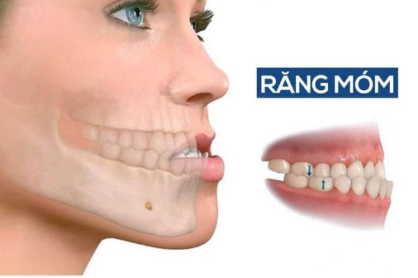 Trường hợp răng móm do lệch khớp hàm