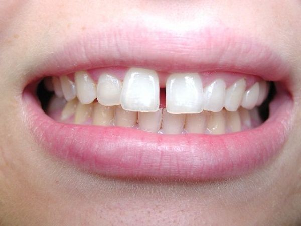 Hình ảnh răng thưa gây mất thẩm mỹ và làm yếu chức năng nhai Hình ảnh răng thưa gây mất thẩm mỹ và làm yếu chức năng nhai