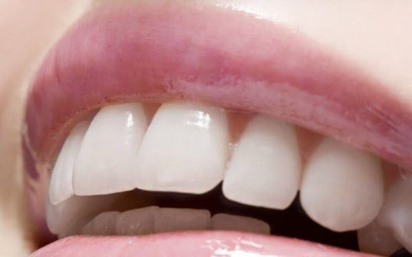 Đây là trường hợp răng hô ở mức độ nhẹ mà bạn thường dễ lầm tưởng và không biết nếu không chụp hình phim Đây là trường hợp răng hô ở mức độ nhẹ mà bạn thường dễ lầm tưởng và không biết nếu không chụp hình phim